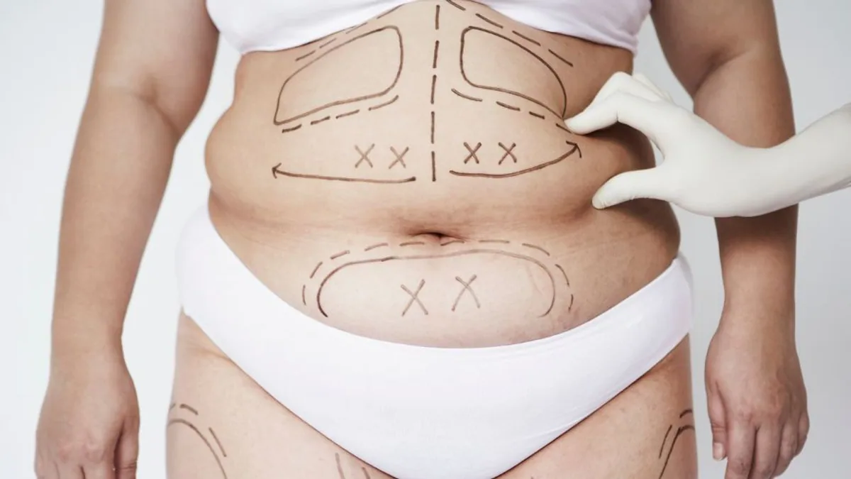 Liposuction