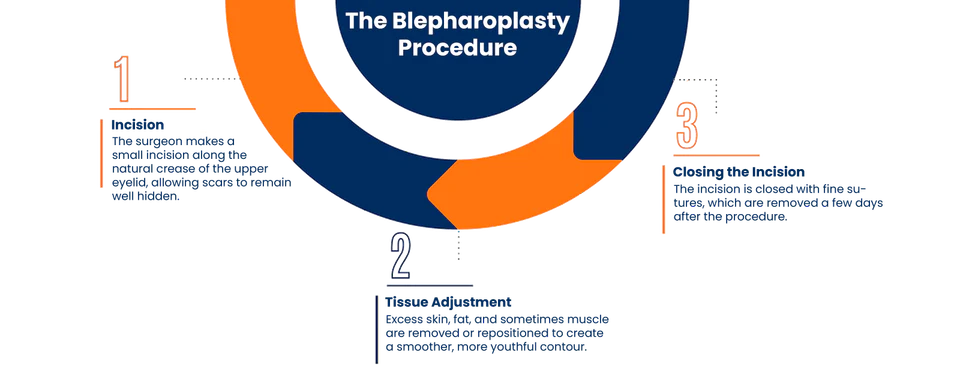 Blepharoplasty procedure illustration
