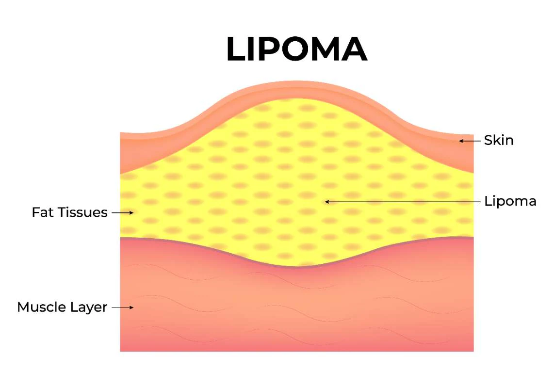 Diagram showing a lipoma beneath the skin