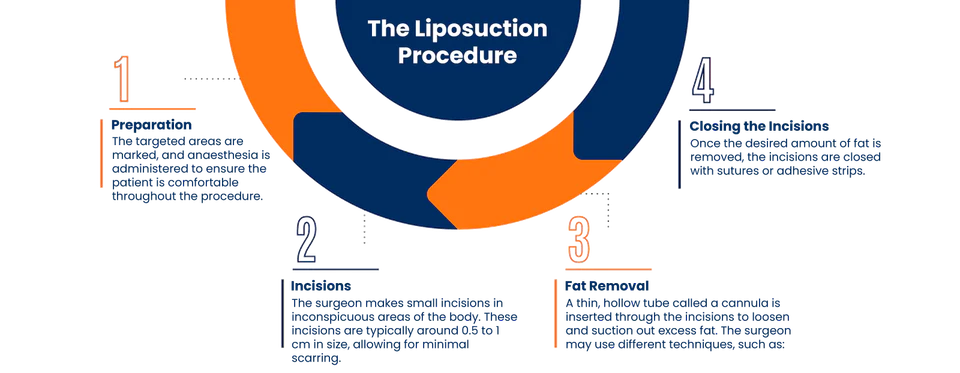 Liposuction procedure illustration