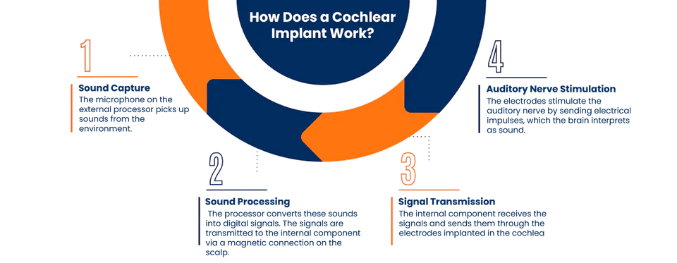 Cochlear implant procedure illustration