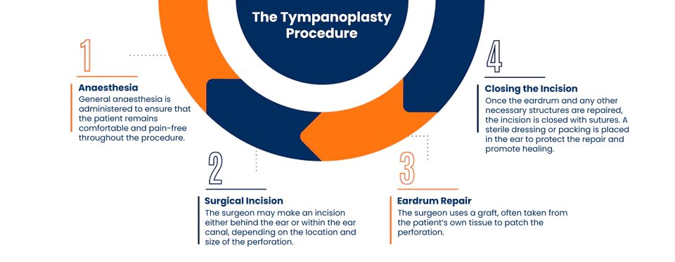 Tympanoplasty eardrum repair procedure illustration