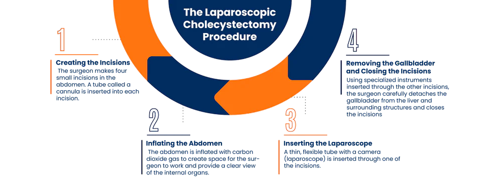 Laparoscopic gallbladder removal procedure illustration