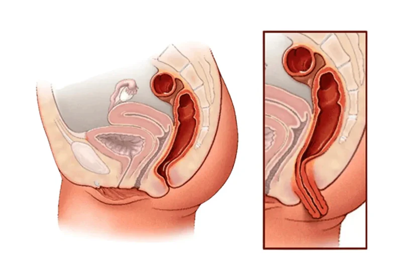 Illustration explaining rectal prolapse