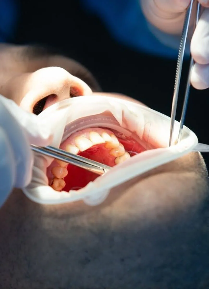 Recovery after commando surgery and reconstruction