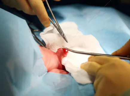 Day-care circumcision being performed in a sterile operating field