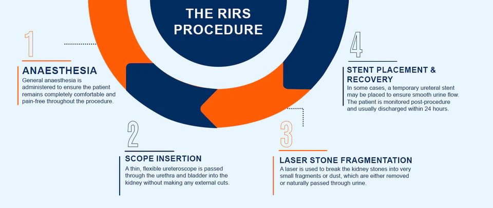 RIRS laser kidney stone removal procedure
