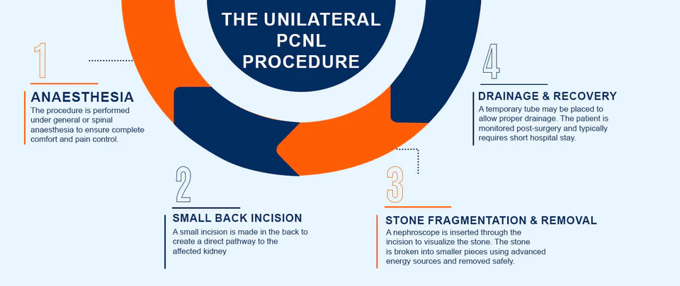 Unilateral PCNL kidney stone removal procedure