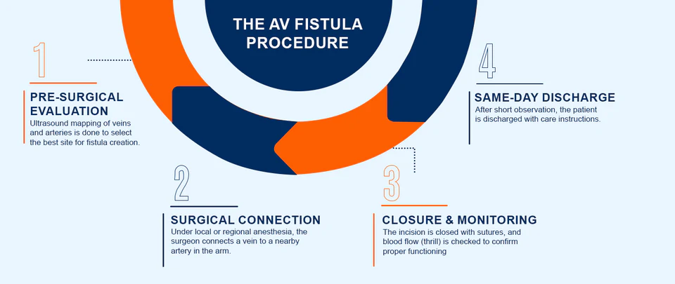 AV fistula creation procedure overview