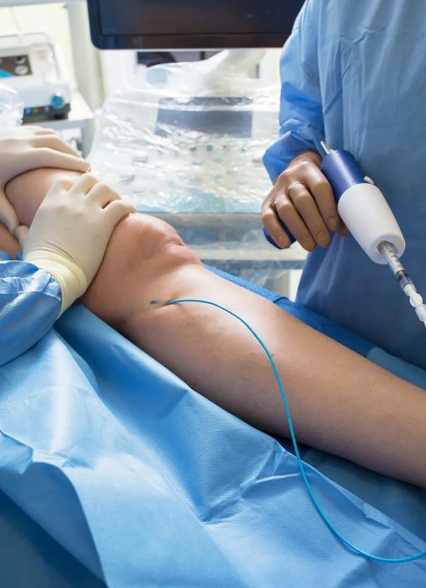 Recovery and aftercare following varicose vein treatment